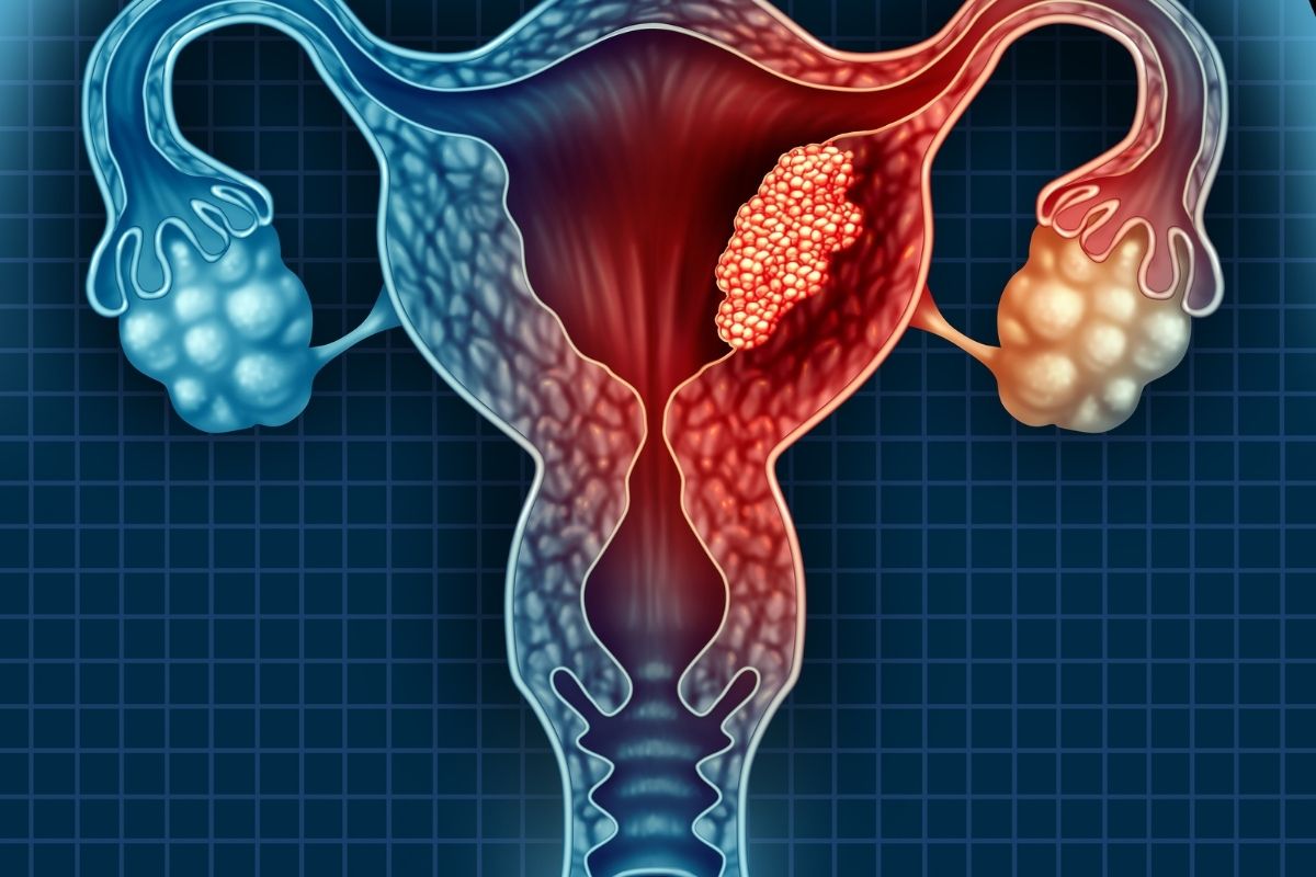 tumore dell'utero