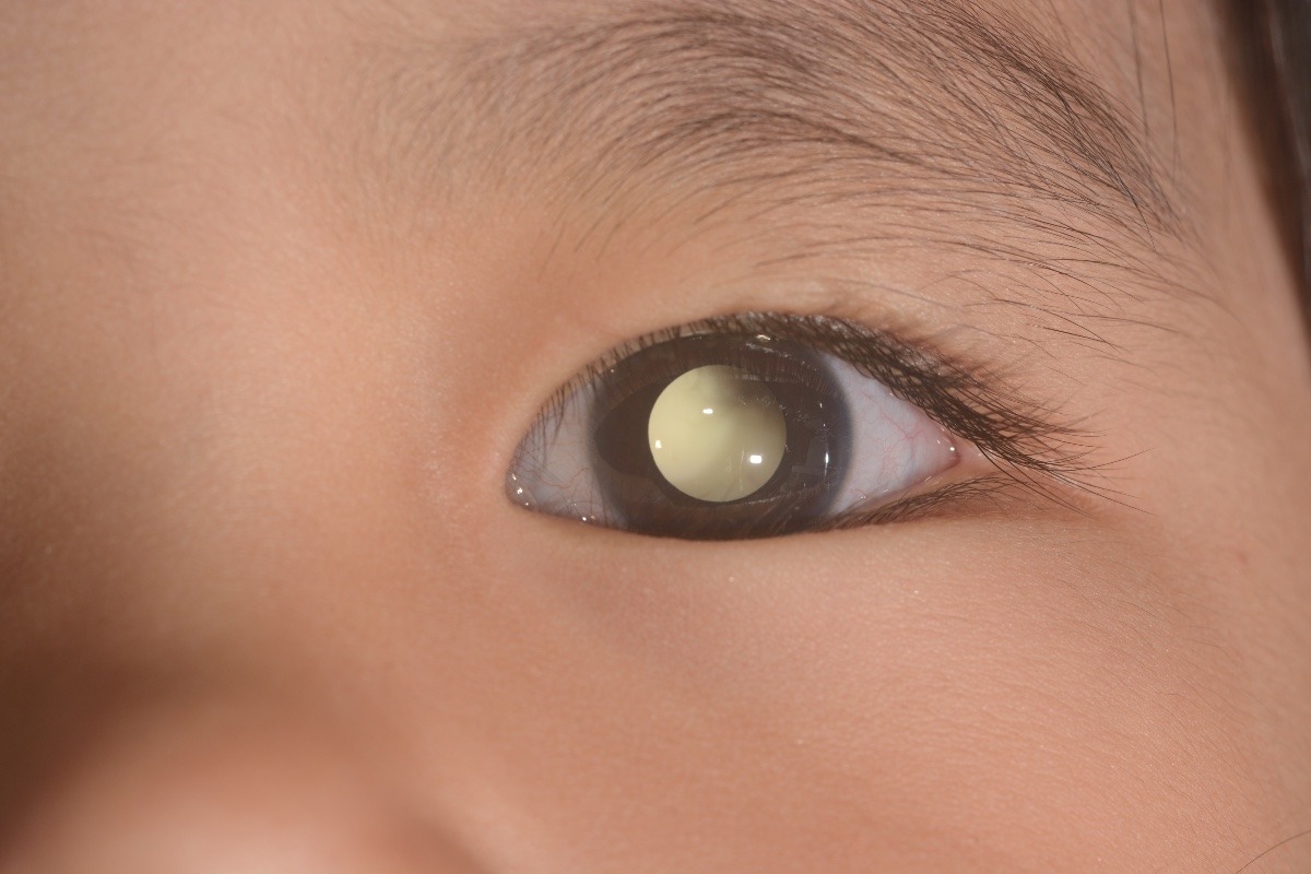Retinoblastoma tumore dell'occhio